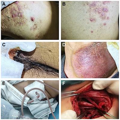 Case report: A case of widespread soft tissue infection and multiple abscesses secondary to hidradenitis suppurativa inducing septic shock caused by Lawsonella clevelandensis in China